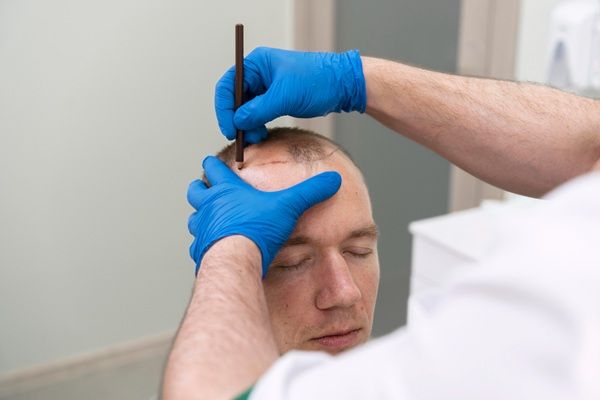 Trasplante capilar Madrid - Médico capilar realizando el boceto del injerto capilar Madrid a un hombre con alopecia para determinar el precio trasplante capilar
