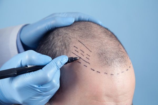 Trasplante capilar Madrid - Médico capilar realizando el boceto del injerto de cabello a un hombre con calvicie para mostrar la evolución trasplante capilar