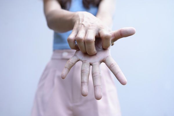 Enfermedad de Dupuytren - Mujer con agarrotamiento manos debido a un bulto en la palma de la mano que causa problemas de movilidad