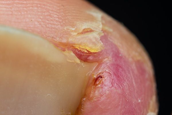 Herpes genital - Granos en labios genitales y herpes en pene por el contagio en relaciones sexuales sin usar protección