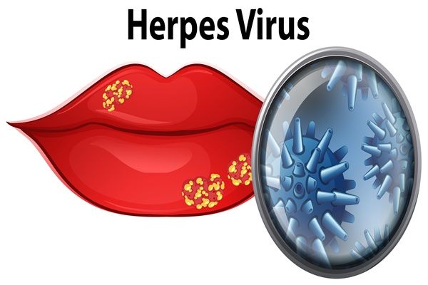 Herpes genital - Representación gráfica de granos en labios genitales por el contagio de diferentes tipos de herpes