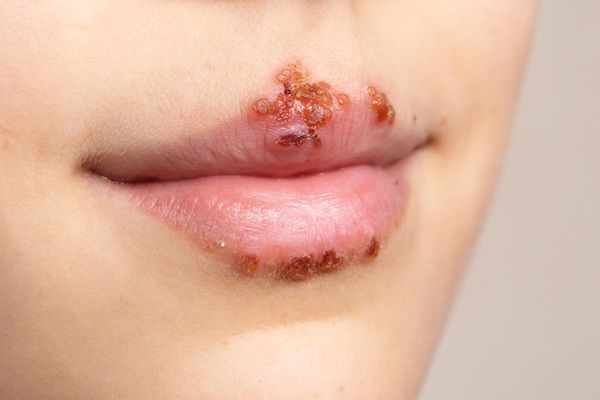 Herpes genital - Persona con granos en labios genitales por el contacto con herpes en pene durante relaciones sexuales sin protección