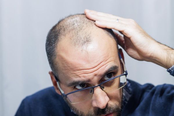 Tratamientos para la alopecia - Hombre con calvicie en las entradas mirándose al espejo antes de un implante capilar Madrid en la mejor clínica injerto capilar Madrid