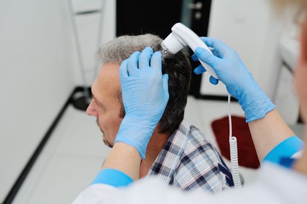 Tratamientos para la alopecia - Tricólogo evaluando el cuero cabelludo de un hombre con calvicie para realizar un implante capilar Madrid en la mejor clínica injerto capilar Madrid