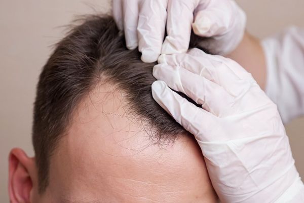 Injerto capilar en Madrid - Mejor cirujano capilar España evaluando el cuero cabelludo de un hombre con pérdida de cabello en las entradas para realizar un trasplante capilar Madrid