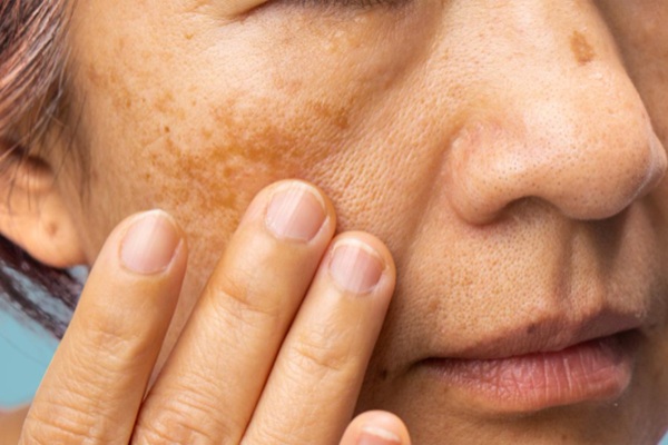 Manchas en la piel - Mujer con manchas en la cara debido al paso del tiempo y el uso de productos cosméticos que afectan la piel