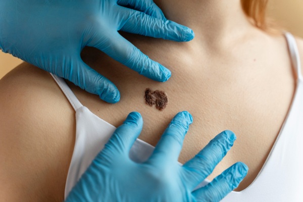 Tipos de cáncer - Médico especialista evaluando los síntomas del cáncer de piel de una mujer por el desarrollo de un carcinoma