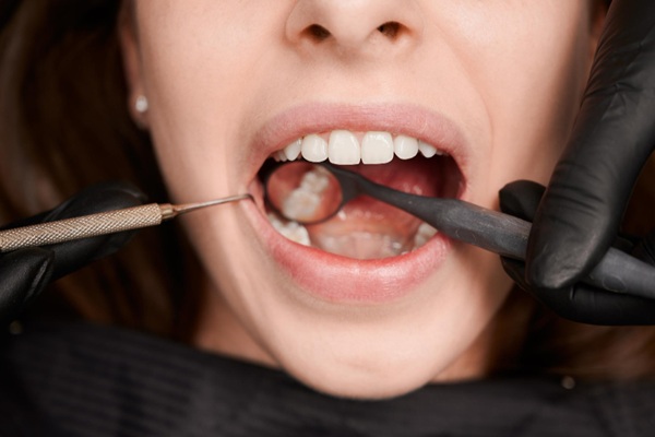 Enfermedades bucales - Odontólogo revisando los dientes de una mujer para detectar caries y enfermedades en los dientes