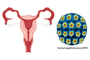 Enfermedades de transmisión sexual - Imagen representativa del aparato reproductor femenino con síntomas de ETS a causa del virus del papiloma humano VPH