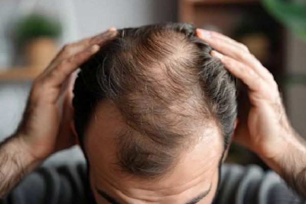hombre muestra su alopecia antes de ponerse en manos de los mejores doctores injerto capilar España